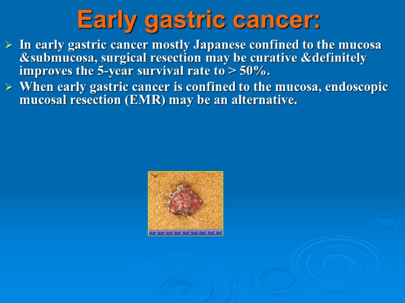 Early gastric cancer: In early gastric cancer mostly Japanese confined to the mucosa &submucosa,